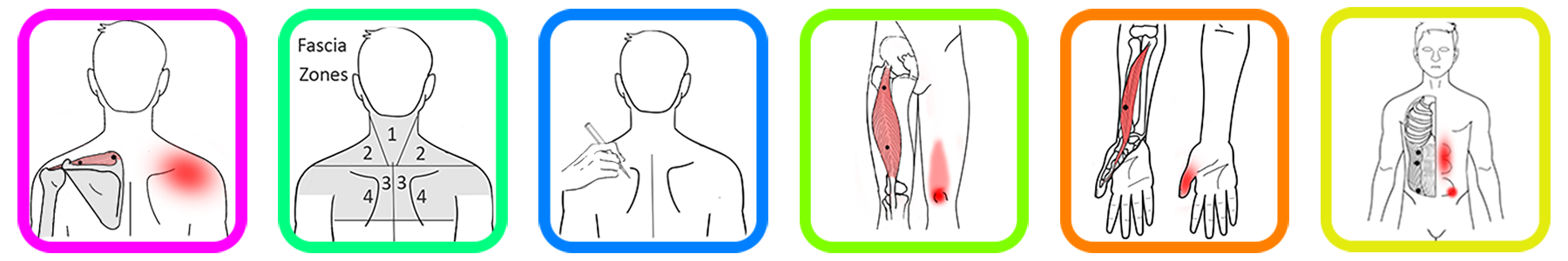 Targeting Myofascial Trigger Points: Advanced Techniques for TENS and Microcurrent Devices Targeting Myofascial Trigger Points: Advanced Techniques for TENS and Microcurrent Devices